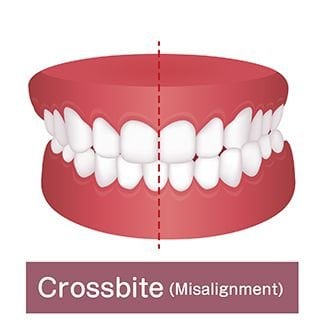 crossbite