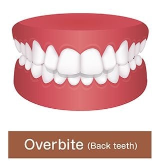 overbite