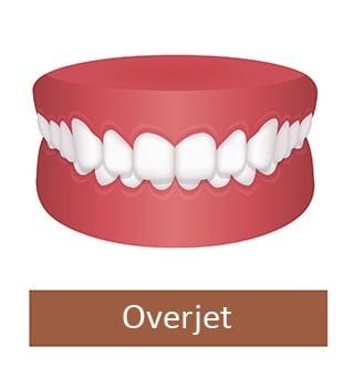 overjet