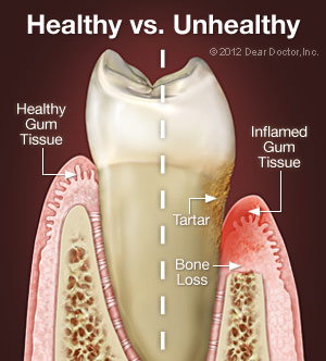 Periodontal Disease.