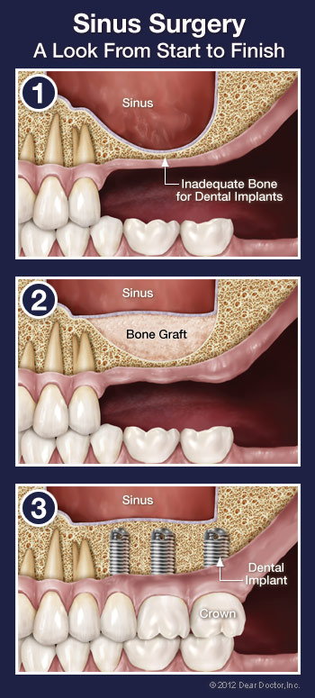 Sinus surgery step by step.