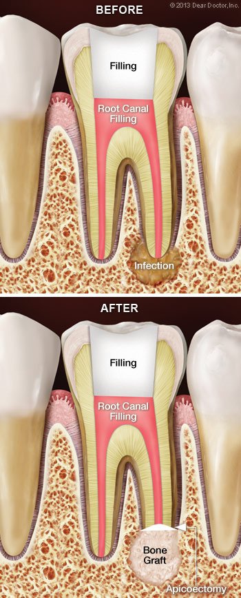 Root canal surgery apicoectomy.